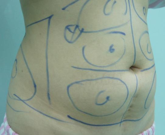 ������֬Ч���ò��ã�������֬ע��ʲô��