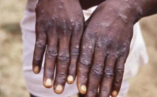 ���ȸ�Ⱦ�ﶻ�����Ŀ����Դ�� �˸�Ⱦ�ﶻ������������