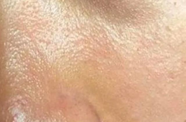 Ę�ϳ����a��SB2���Ԇ� �沿�������Ը���Ę�����͆�